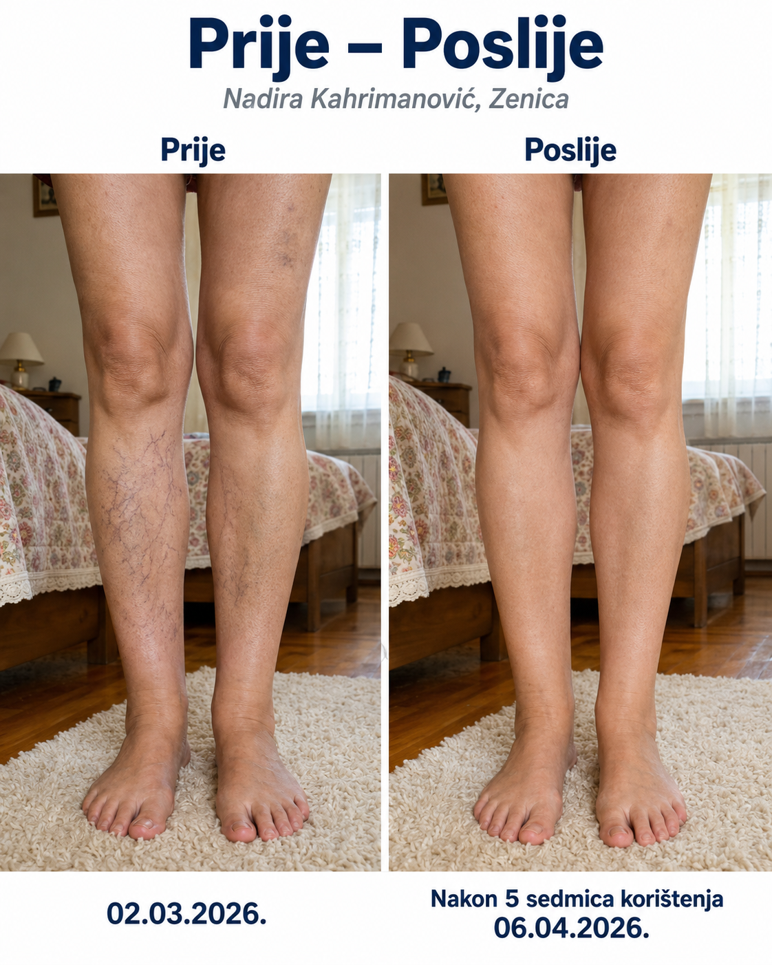Prije i poslije korištenja Sophia kreme — kupac 2